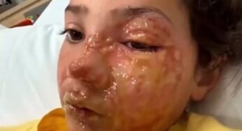 Menina de 10 anos sofre queimaduras graves no rosto após desafio viral do TikTok com brinquedo squishy