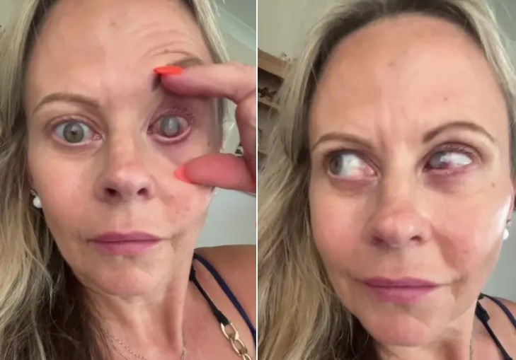 Emma Marsden teve uma córnea devorada por ameba — Foto: Reprodução/TikTok