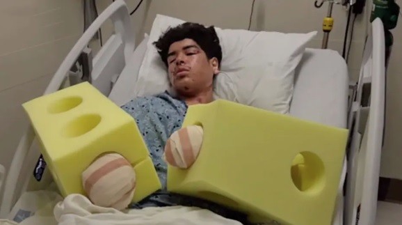 Jovem luta contra amputações após fogo de artifício ilegal explodir nas suas mãos na Califórnia — Foto: Reprodução