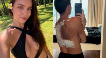 Influenciadora russa tem 30% do corpo queimado após explosão de power bank em sua cama