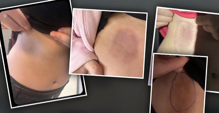 Aluna de escola no Arizona (EUA) ficou com hematomas após ser alvejada por ex com bolas de queimada durante aula de educação física — Foto: Reprodução