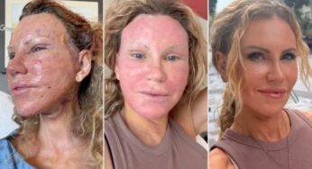 Paciente compartilha recuperação de facelift sem filtros e redefine expectativas sobre cirurgias estéticas