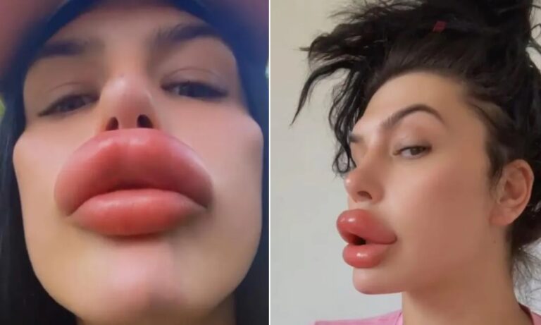 Britânica Sofia Lips está atrás do recorde de maiores lábios turbinados do mundo — Foto: Reprodução/Instagram