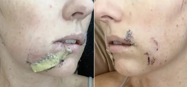 Brittany Cardinal foi mordida no rosto por coiote ao salvar a filha de ataque no Arizona (EUA) — Foto: Reprodução