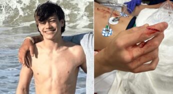 Jovem de 13 anos enfrenta recuperação complexa após ataque de castor raivoso em lago nos EUA