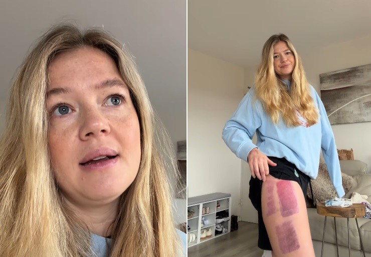 Leah Stewart mostra partes de pele da coxa esquerda que foram retiradas para enxerto na esquerda, ferida em ataque de tubarão — Foto: Reprodução/Instagram