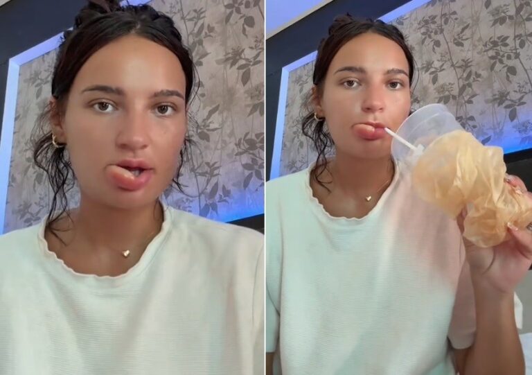 Compulsão: influencer Gina Bugden ficou com lábio deformado ao 'mastigá-lo' quando dormia — Foto: Reprodução/TikTok