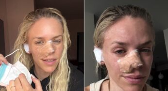 Jornalista Julie Stewart-Binks reconstrói nariz com parte da orelha após remover câncer de pele