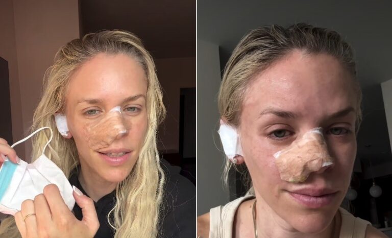 Apresentadora de TV Julie Stewart-Binks tirou parte de orelha para reconstruir o nariz após remover câncer que 'parecia espinha' — Foto: Reprodução/Instagram